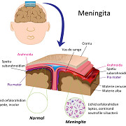 cum se manifesta meningita meningococica boala care a doborat-o pe nepoata de 11 ani a astronautului dumitru prunariu